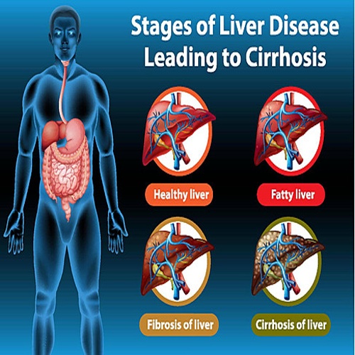 Liver Cirrhosis