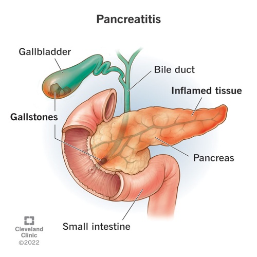 Pancreatic Tumors