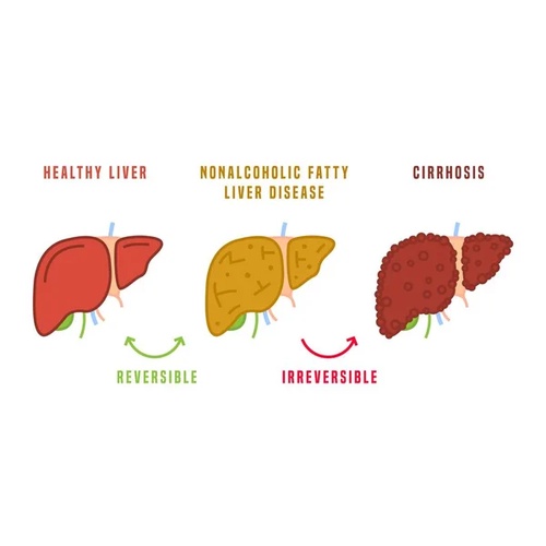 Fatty Liver Disease