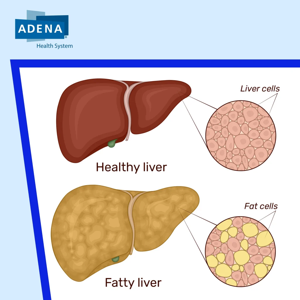 fatty liver