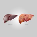 When is Liver Transplant Needed