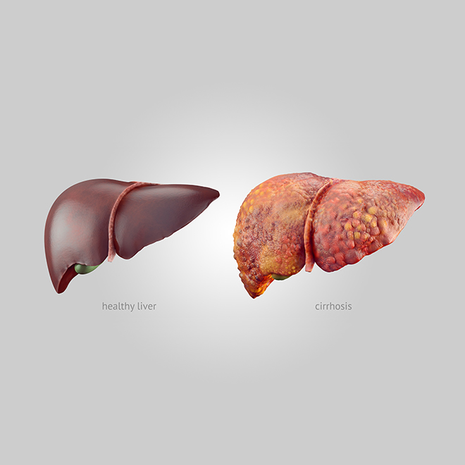 Understanding the conditions that require transplant surgery.